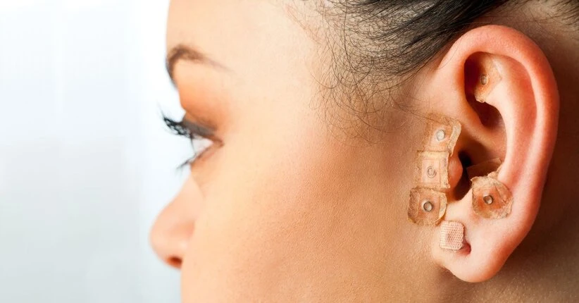 Auricoloterapia: stimolazione dei punti riflessi del padiglione auricolare